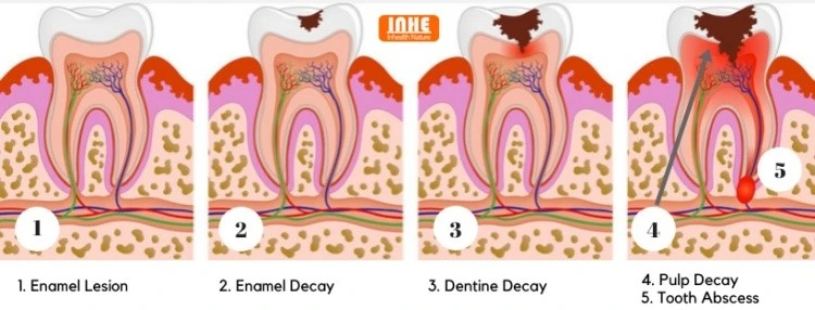 Stages of Tooth Decay Stages of Tooth Decay